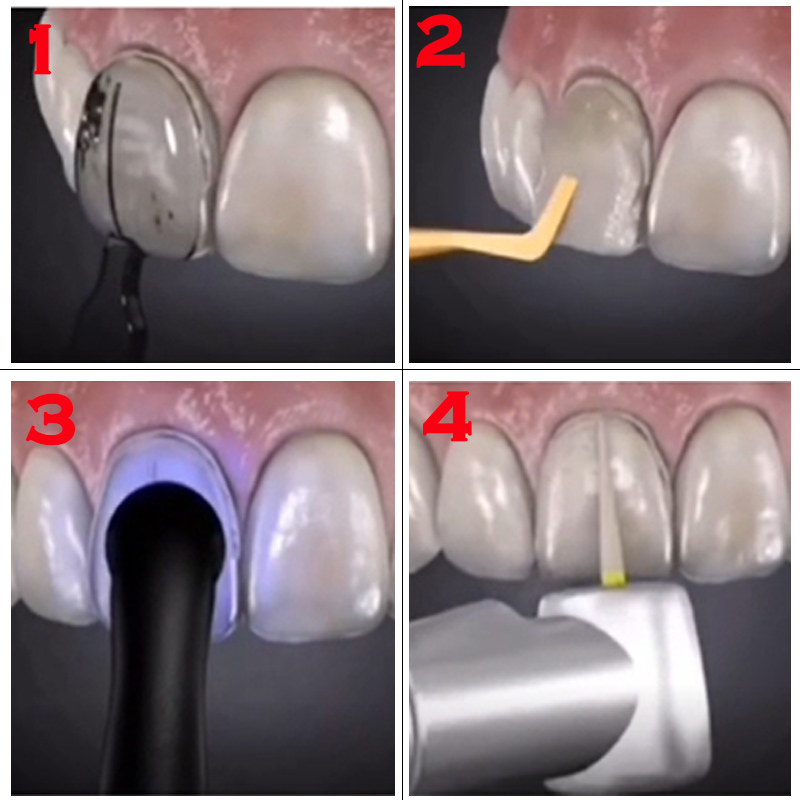 32-teiliges Zahnaufhellungs-Se – Teeth Whitening Moulds Bewertung und Preis