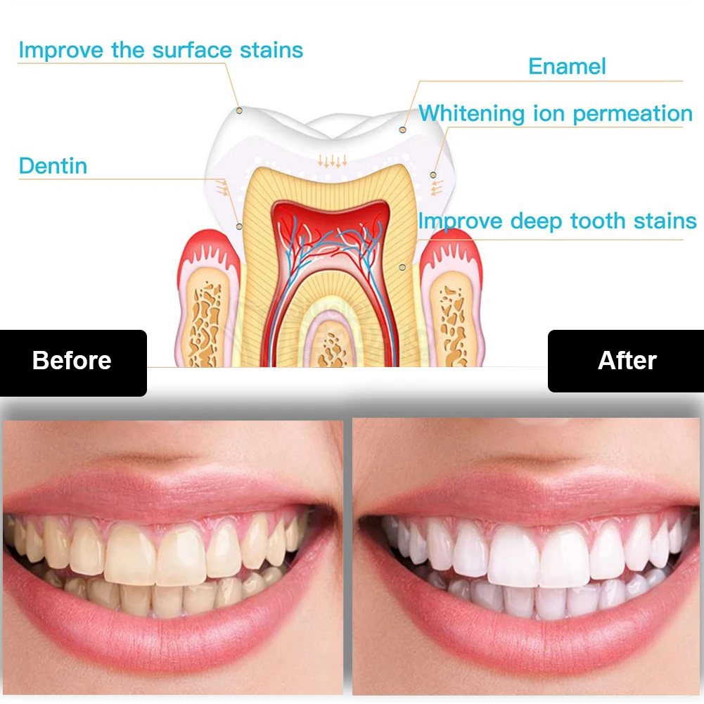 Dental Zahnaufhellung Kit Mini – Teeth Whitening Near Me Bewertung und Preis