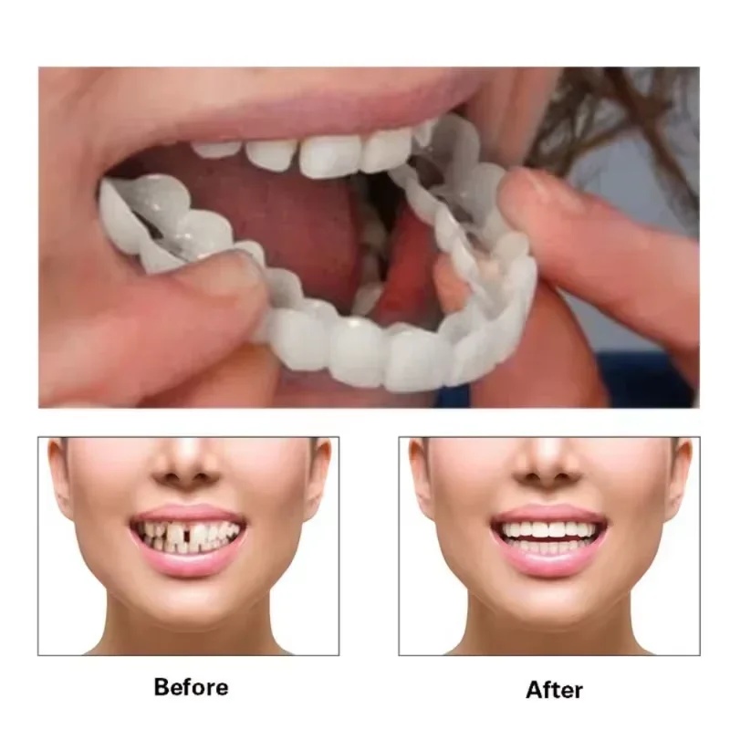 Snap-on-Furnier-Zahnsatz, vers – Teeth Whitening Kit Bewertung und Preis